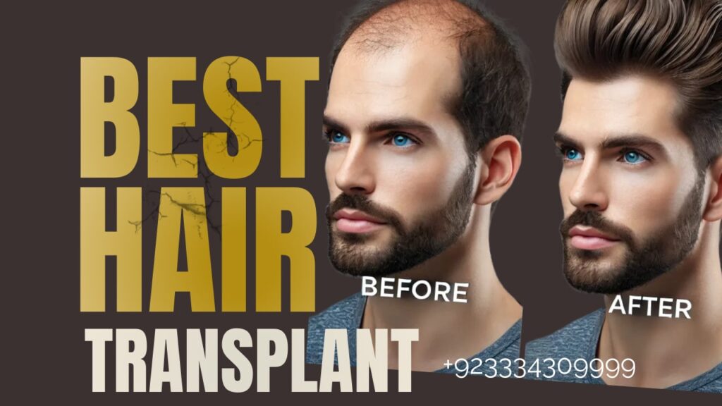 Expectation after hair transplant surgery Lahore Pakistan